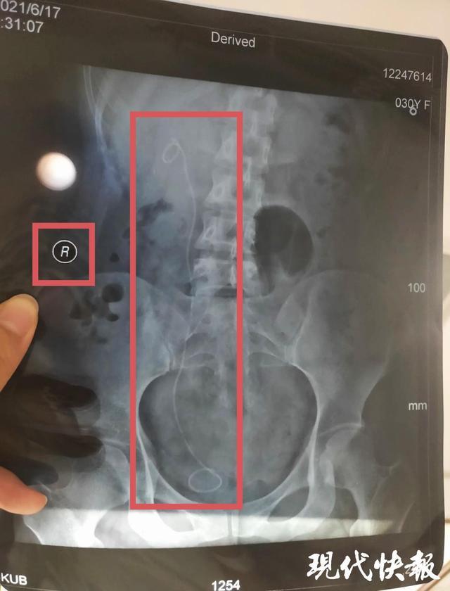 进正常输尿管三名医生医疗事故仅处罚一助手PG电子游戏麻将胡了医生左右不分把支架装(图3)